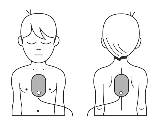 Diagram showing front and back placement of Philips HeartStart FRx AED pads on a child's chest and back